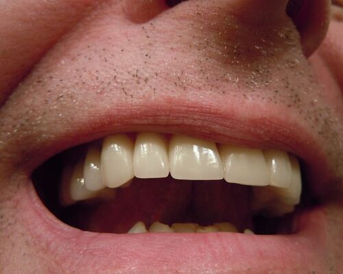 teeth-dental-tooth-mouth