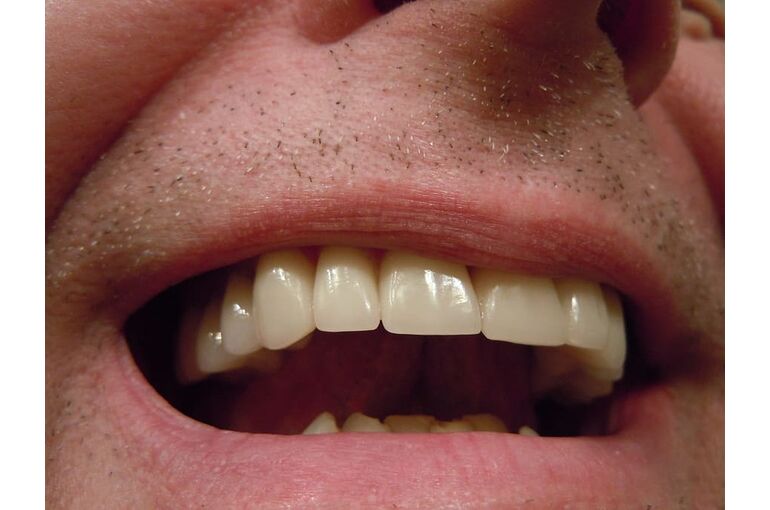 teeth-dental-tooth-mouth