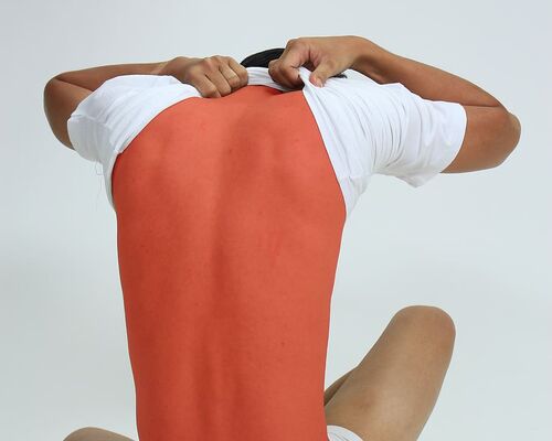 sun-burn-pain-skin-burn-red-dermatology