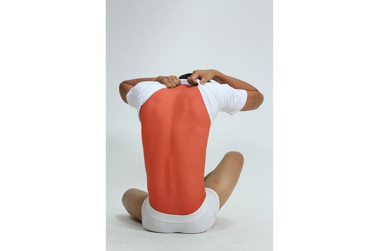 sun-burn-pain-skin-burn-red-dermatology